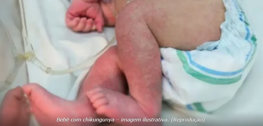 MS registra 19ª morte por chikungunya e concentra 70% dos óbitos do Brasil