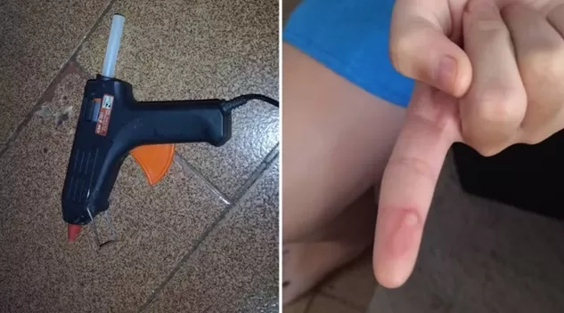 Mães denunciam professora suspeita de queimar alunos com cola quente durante aula de artes em escola